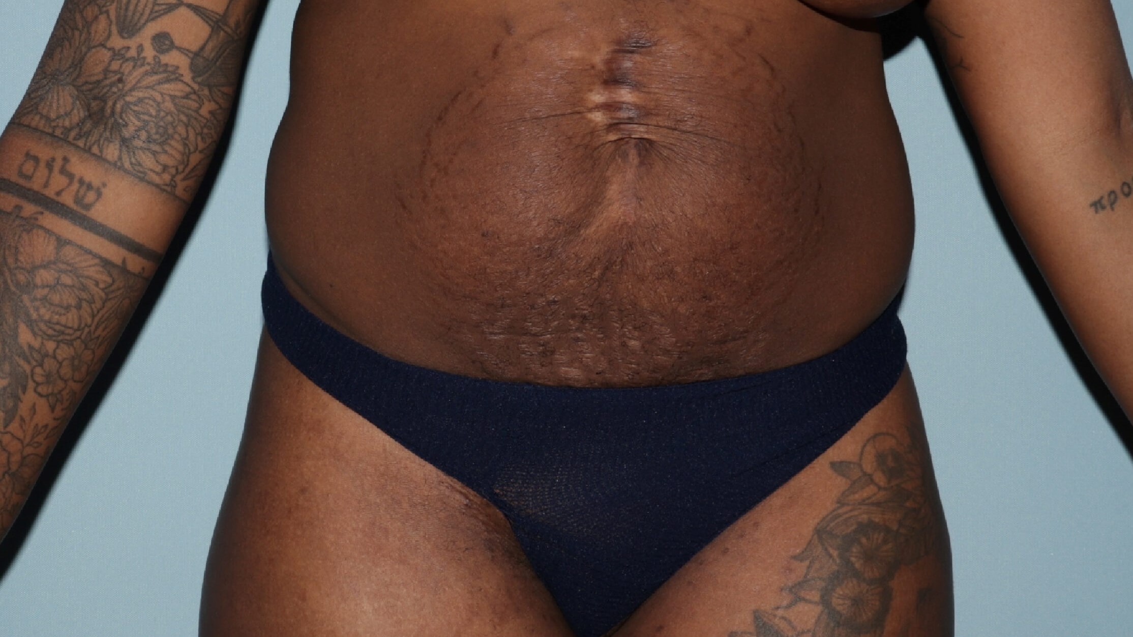 Tummy Tuck with Prior Abdominal Scars